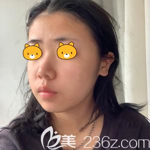 到武汉艺星做埋线提升术前脸部松弛的自己 到武汉艺星做埋线提升术前脸部松弛的自己