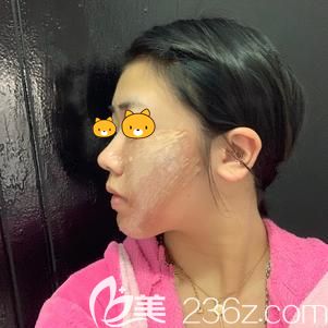 <!--<i data=20240703-sp></i>-->主任帮我做埋线提升术后即刻面部松弛改善 <!--<i data=20240703-sp></i>-->主任帮我做埋线提升术后即刻面部松弛改善