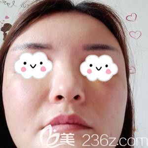 在长沙星雅做自体脂肪填充面部术后6天照 在长沙星雅做自体脂肪填充面部术后6天照