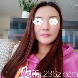 在长沙做自体脂肪填充面部半个月时效果 在长沙做自体脂肪填充面部半个月时效果