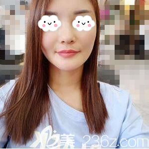 找长沙星雅李雯院长做自体脂肪填充全脸术后30天恢复效果图 找长沙星雅李雯院长做自体脂肪填充全脸术后30天恢复效果图