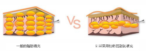 广州紫馨梁进华医生自体脂肪注射技术优势 广州紫馨梁进华医生自体脂肪注射技术优势