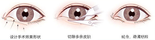 广州紫馨冯传波双眼皮手术过程