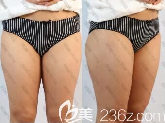 做吸脂瘦大腿术前照 做吸脂瘦大腿术前照