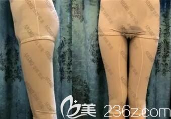 在华韩华美做大腿吸脂术后10天效果 在华韩华美做大腿吸脂术后10天效果