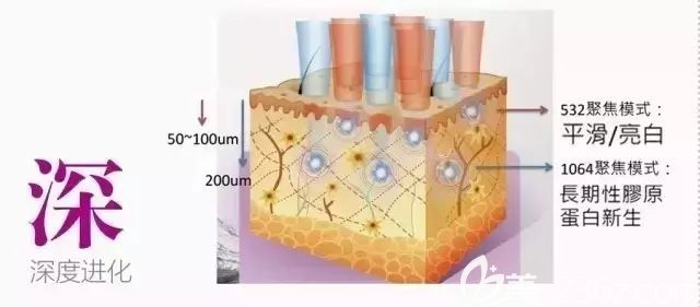超皮秒祛斑深层穿透刺激胶原蛋白 超皮秒祛斑深层穿透刺激胶原蛋白