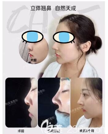 太原欧美莲整形医院姚冰鼻综合案例