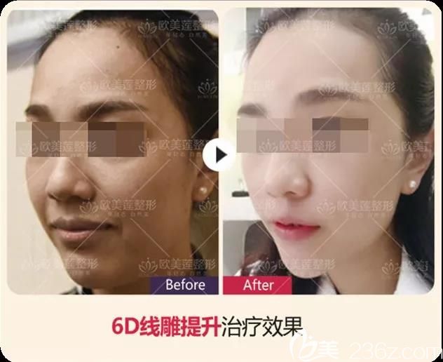 太原欧美莲姚冰全脸埋线提升案例