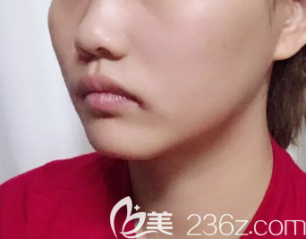 菏泽隆鼻术前照片 菏泽隆鼻术前照片