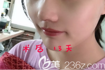 菏泽华美做假体隆鼻手术挺好的，并且菏泽华美做隆鼻的价格也不贵