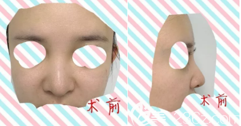 我在德州做玻尿酸隆鼻的术前照片 我在德州做玻尿酸隆鼻的术前照片