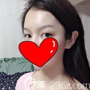 徐国建院长帮我做自体脂肪丰额头术后额头变饱满 徐国建院长帮我做自体脂肪丰额头术后额头变饱满