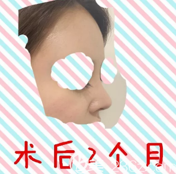 玻尿酸隆鼻术后即刻照片 玻尿酸隆鼻术后即刻照片