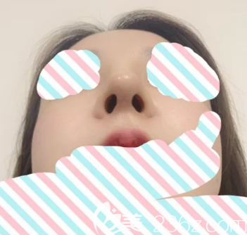 德州玻尿酸隆鼻后鼻尖的形态 德州玻尿酸隆鼻后鼻尖的形态