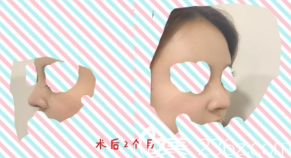 这些年我在德州做玻尿酸隆鼻积攒的一些经验给大家，希望可以帮助到你们