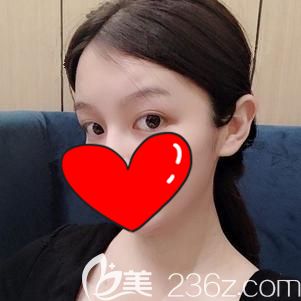 做自体脂肪丰额头术后15天肿胀消除 做自体脂肪丰额头术后15天肿胀消除