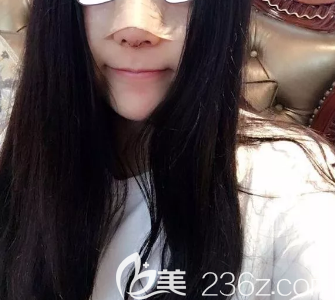 德州做鼻综合术后第五天的样子