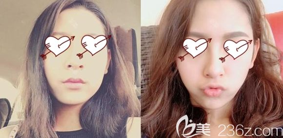 长春中妍整形做面部脂肪移植术后一周效果图 长春中妍整形做面部脂肪移植术后一周效果图