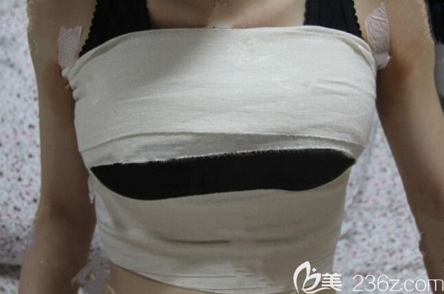 芜湖壹加壹整形自体脂肪填充隆胸术后第4天恢复图 芜湖壹加壹整形自体脂肪填充隆胸术后第4天恢复图