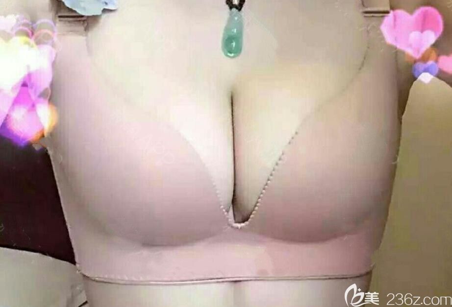 壹加壹整形大腿吸脂+隆胸术后第10天照片 壹加壹整形大腿吸脂+隆胸术后第10天照片