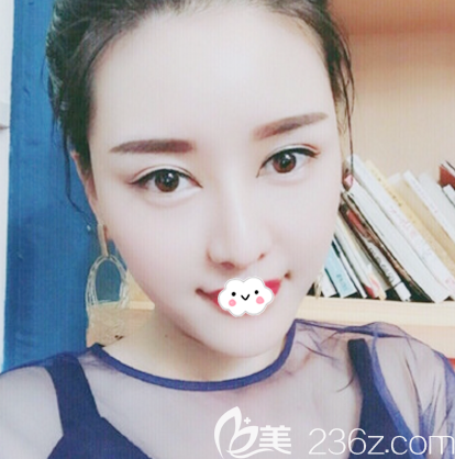 鼻综合隆鼻术后15天效果图