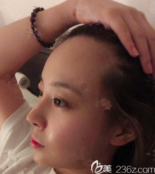 在韩国moplus文珉善做了切开法1800根发际线移植很自然，密度也满意