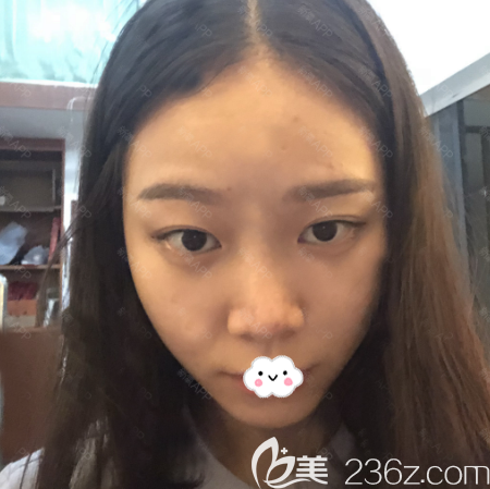 广州韩妃医学整形美容门诊部牟北平术前照片1