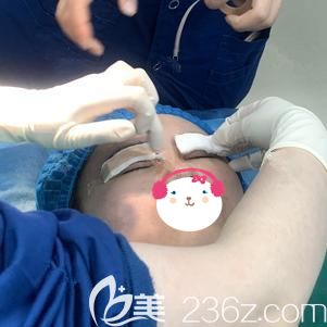 <!--<i data=20240703-sp></i>-->主任帮我做埋线双眼皮术后包扎