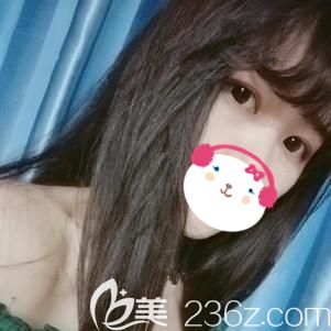 做埋线双眼皮术后8天肿胀消失基本无出血