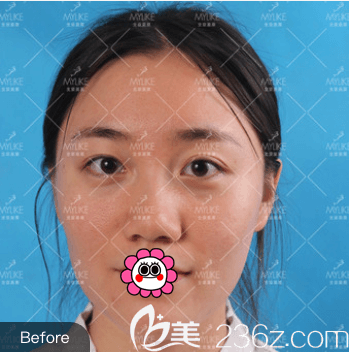 我在北京美莱做自体脂肪丰眼窝前样子 我在北京美莱做自体脂肪丰眼窝前样子