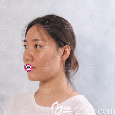 <!--<i data=20240703-sp></i>-->医生给我做自体脂肪丰眼窝第3天样子 <!--<i data=20240703-sp></i>-->医生给我做自体脂肪丰眼窝第3天样子