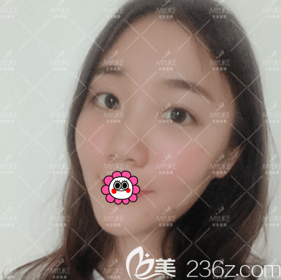 北京美莱自体脂肪丰眼窝案例 北京美莱自体脂肪丰眼窝案例