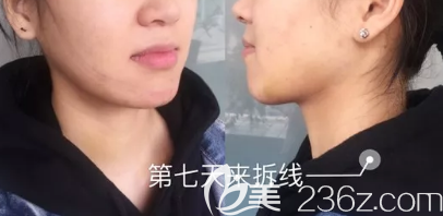 在德州做下颌角+颧骨术后第7天的样子