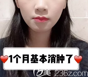 德州做下颌角+颧骨手术术后一个月