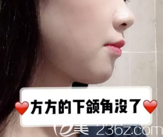 看吧！天生脸大的我在德州做了切除下颌角+颧骨手术，术后第7天我都开心了