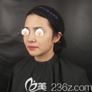 在武汉艺星做玻尿酸填充前面部凹陷的自己 在武汉艺星做玻尿酸填充前面部凹陷的自己