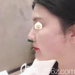 做玻尿酸丰苹果肌术后15天肿胀消除 做玻尿酸丰苹果肌术后15天肿胀消除