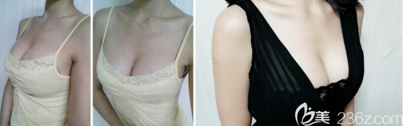 在韩国DA整形具贤国那做了水滴隆胸，效果真的好好再也没人叫我太平公主了