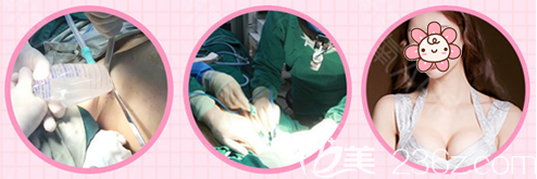 深圳yestar牛克辉隆胸案例和手术过程图