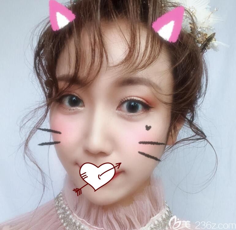 合肥福华整形鼻综合+埋线术后第13天恢复情况