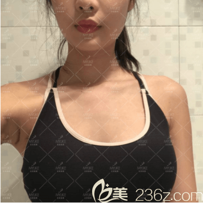 我在北京美莱做曼托毛面假体隆胸第7天样子