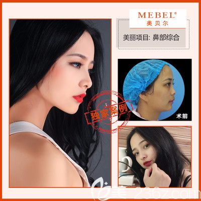 在南京美贝尔做鼻综合案例