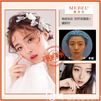 在南京美贝尔做双眼皮案例