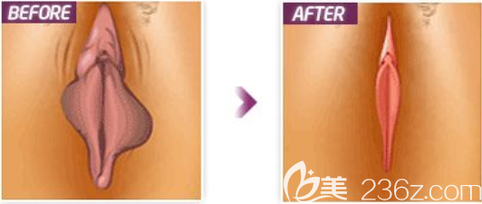 说说我在韩国丽姿做私密整形感受：切除阴蒂包皮、阴蒂会阴除皱、私密美白