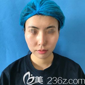 面诊泰州丽都术前面颊凹陷 面诊泰州丽都术前面颊凹陷