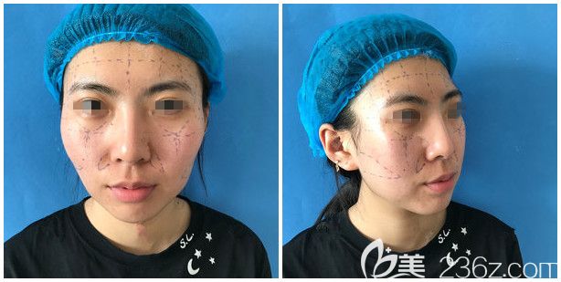 面诊泰州丽都医生设计术前脂肪填充方案 面诊泰州丽都医生设计术前脂肪填充方案