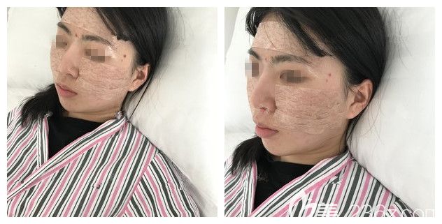 刚做完自体脂肪填充术后即刻效果 刚做完自体脂肪填充术后即刻效果