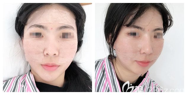 自体脂肪填充面部术后三天恢复 自体脂肪填充面部术后三天恢复