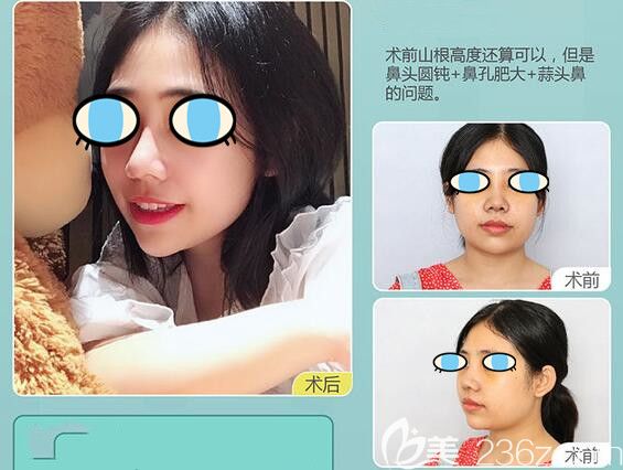 南宁华美整形胡凯鼻综合隆鼻案例
