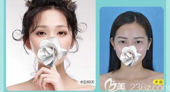 南宁华美整形胡凯全切双眼皮案例